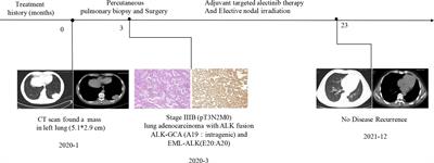 Case Report: A Novel Non-Reciprocal ALK Fusion: ALK-GCA and EML4-ALK Were Identified in Lung Adenocarcinoma, Which May Respond to Alectinib Adjuvant-Targeted Therapy